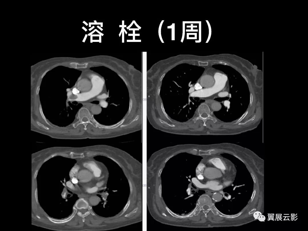 影像PPT - 【PPT】肺栓塞影像诊断与鉴别-18