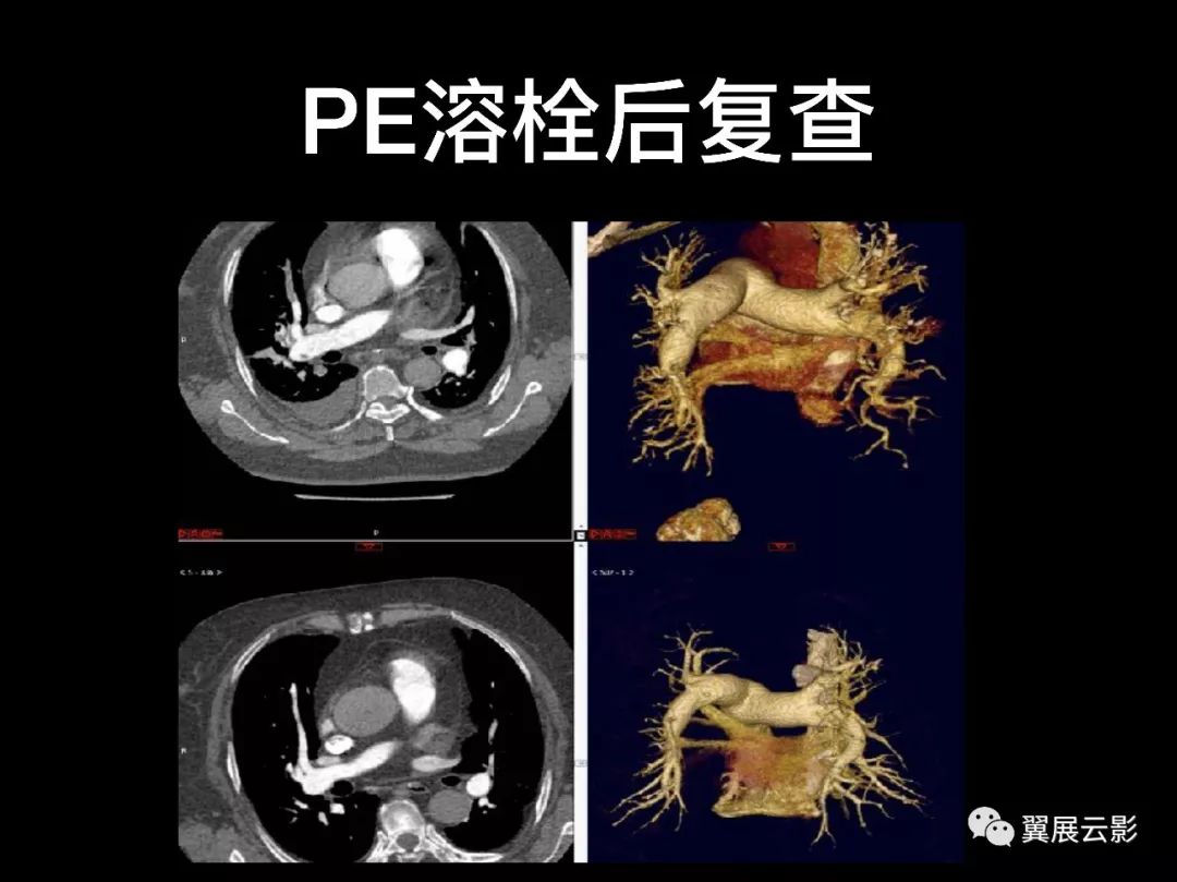 影像PPT - 【PPT】肺栓塞影像诊断与鉴别-19