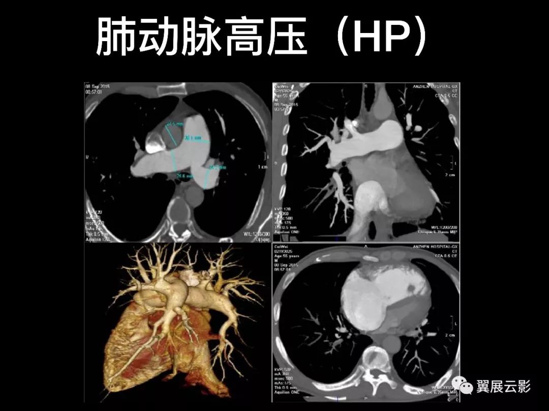 影像PPT - 【PPT】肺栓塞影像诊断与鉴别-20