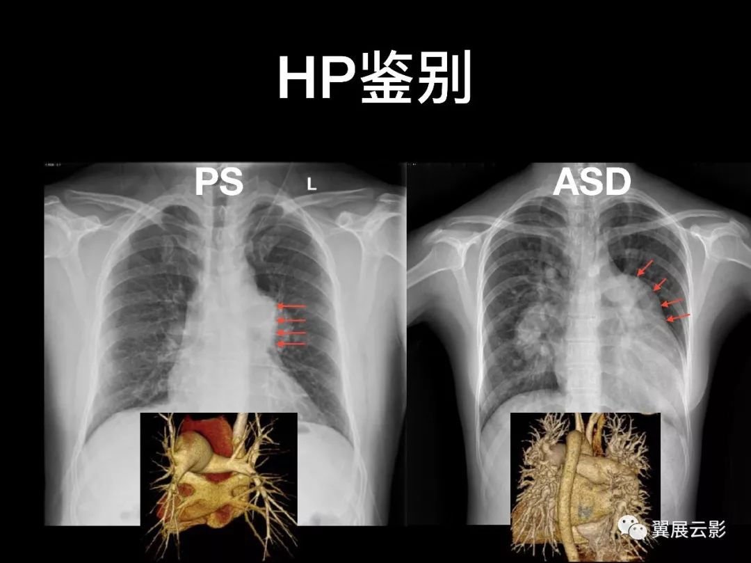 影像PPT - 【PPT】肺栓塞影像诊断与鉴别-21