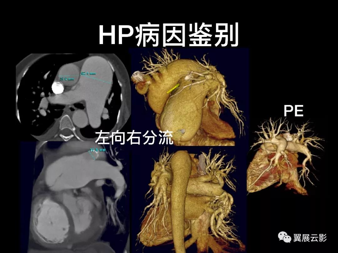 影像PPT - 【PPT】肺栓塞影像诊断与鉴别-23
