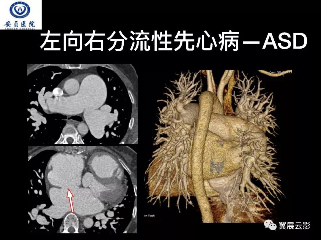 影像PPT - 【PPT】肺栓塞影像诊断与鉴别-24