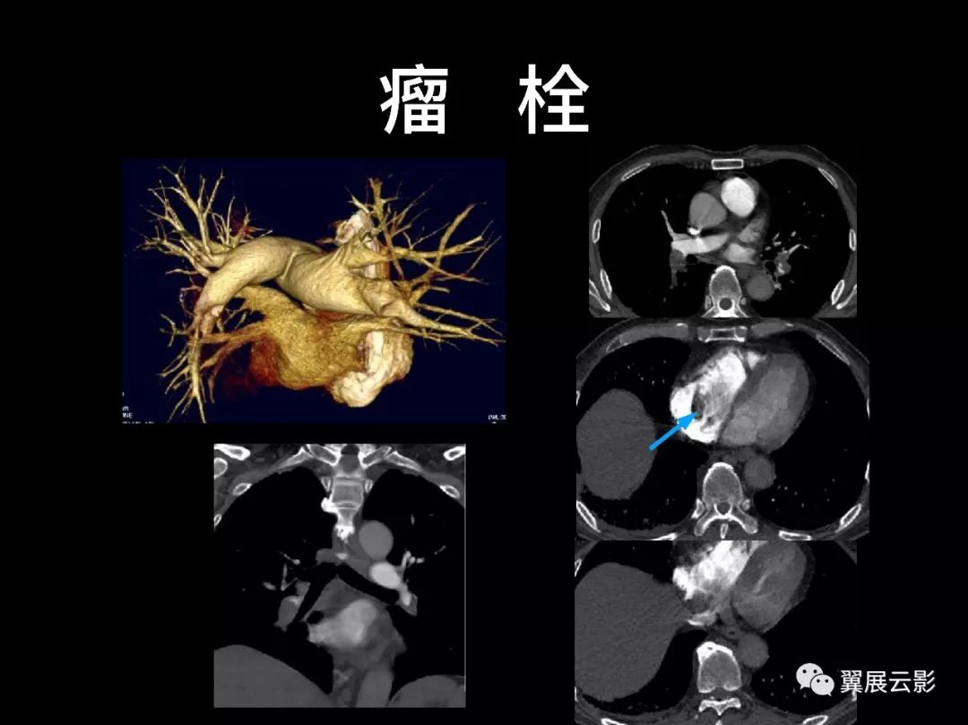 影像PPT - 【PPT】肺栓塞影像诊断与鉴别-26