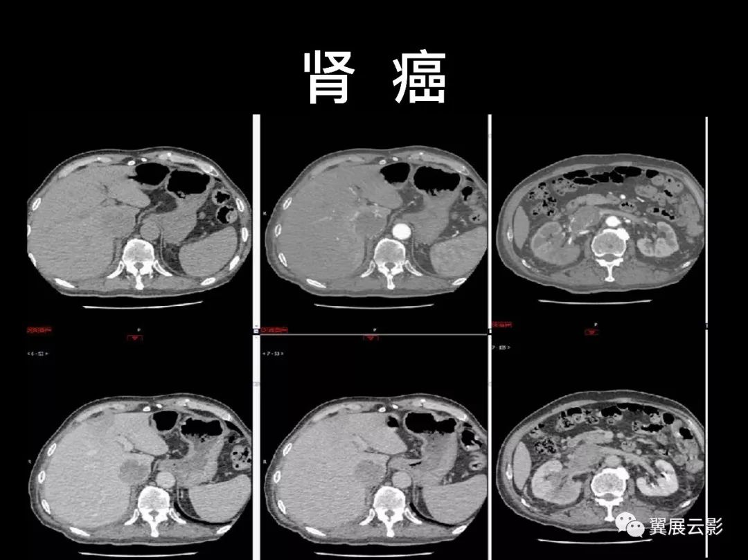 影像PPT - 【PPT】肺栓塞影像诊断与鉴别-27