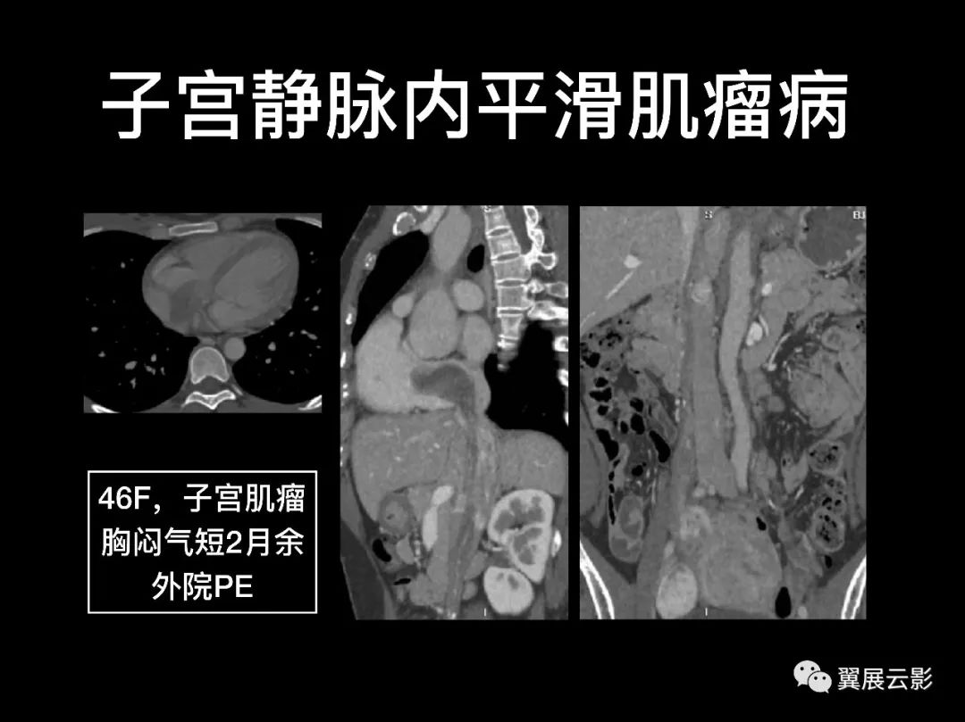 影像PPT - 【PPT】肺栓塞影像诊断与鉴别-29