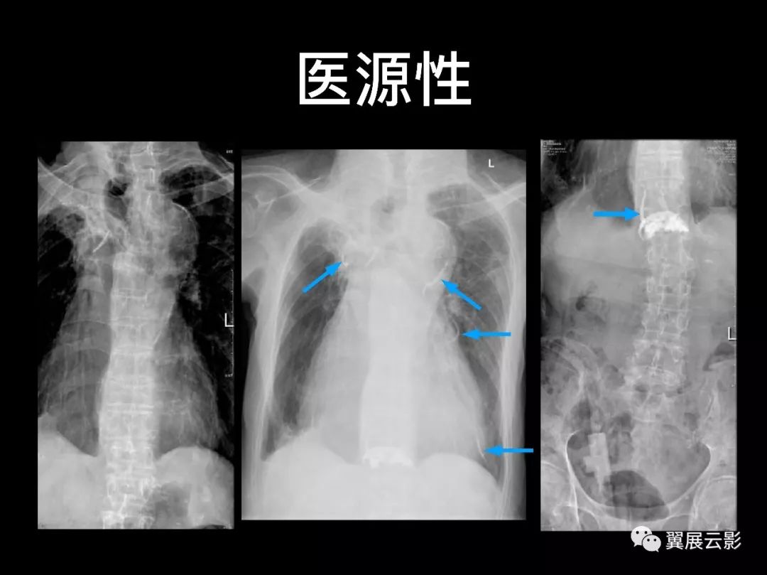影像PPT - 【PPT】肺栓塞影像诊断与鉴别-31