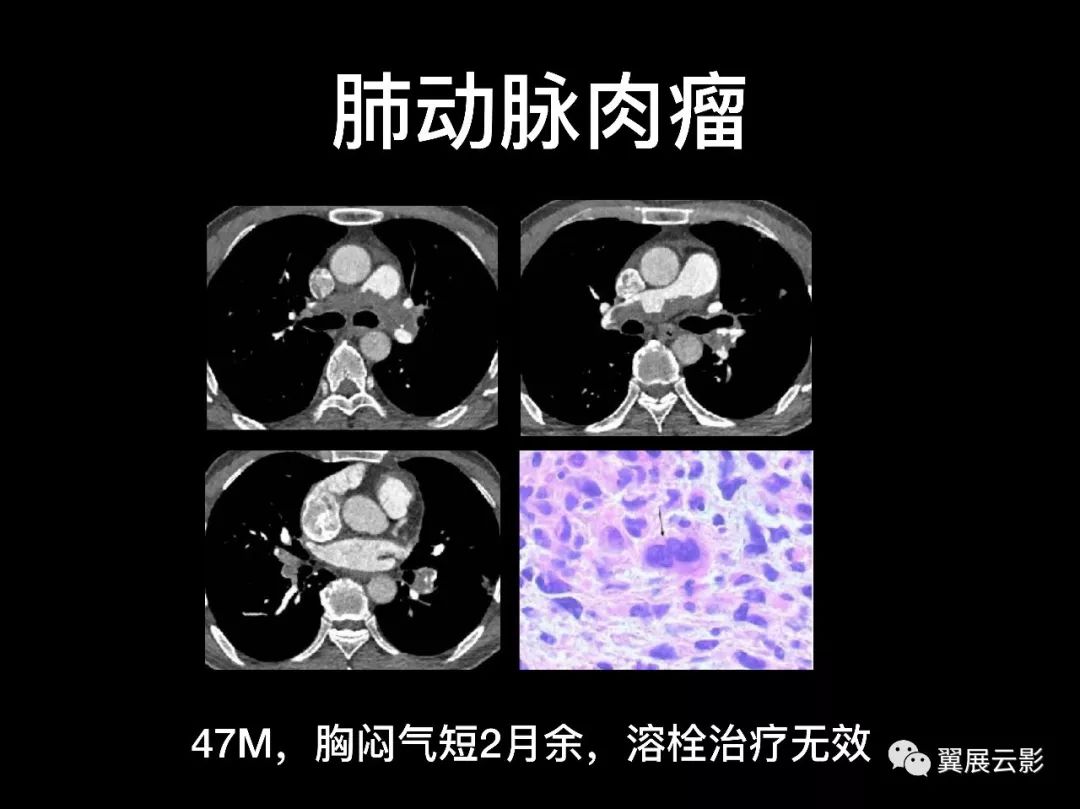 影像PPT - 【PPT】肺栓塞影像诊断与鉴别-32