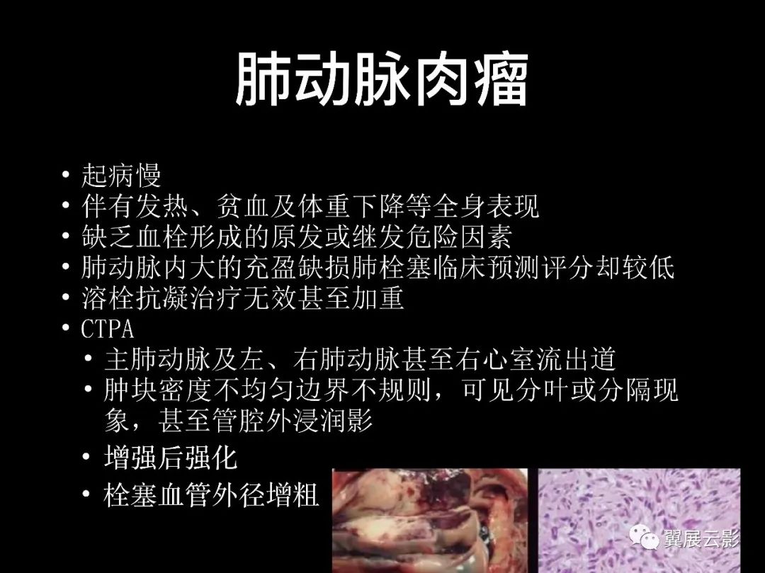 影像PPT - 【PPT】肺栓塞影像诊断与鉴别-33