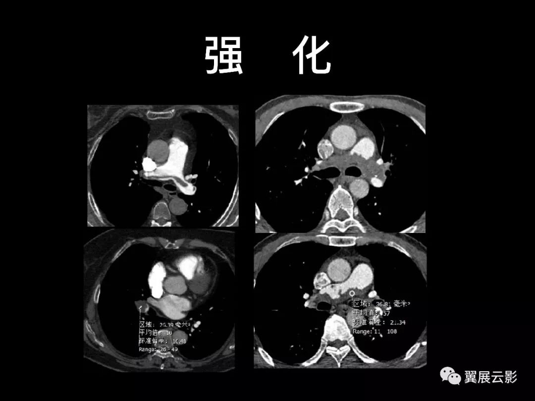 影像PPT - 【PPT】肺栓塞影像诊断与鉴别-34