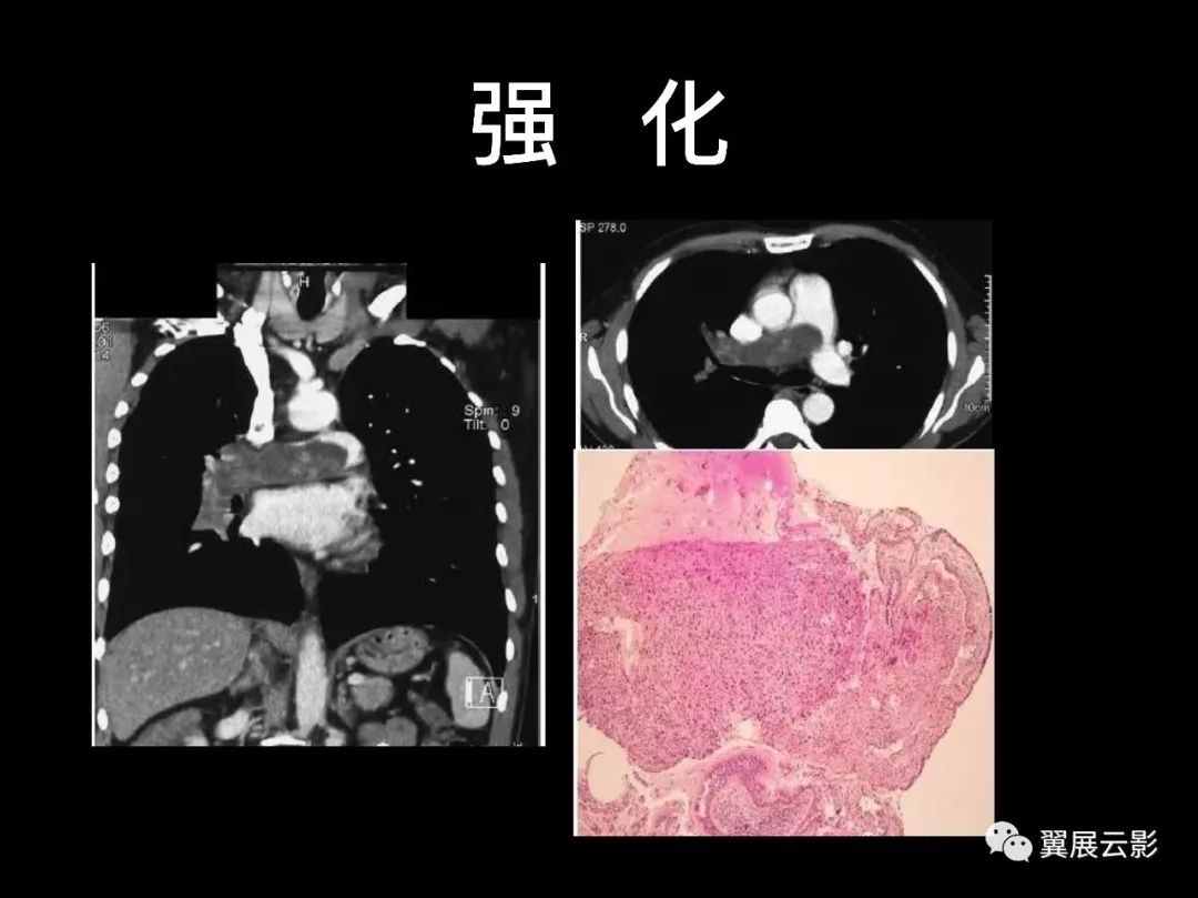 影像PPT - 【PPT】肺栓塞影像诊断与鉴别-35