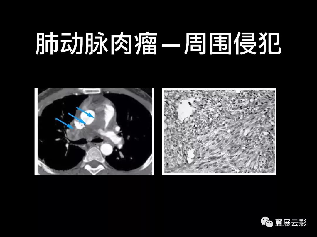 影像PPT - 【PPT】肺栓塞影像诊断与鉴别-36