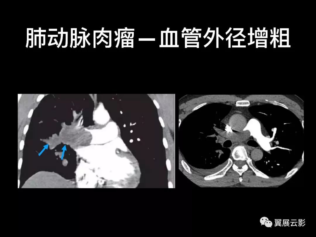 影像PPT - 【PPT】肺栓塞影像诊断与鉴别-37