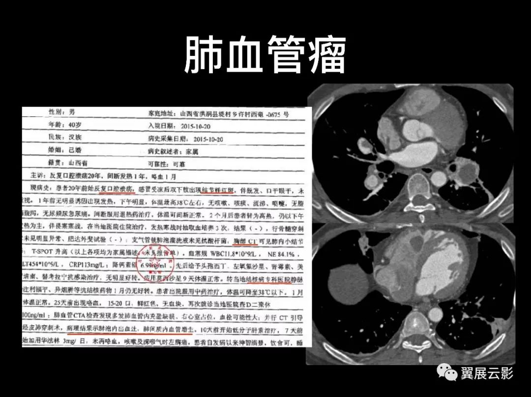 影像PPT - 【PPT】肺栓塞影像诊断与鉴别-38