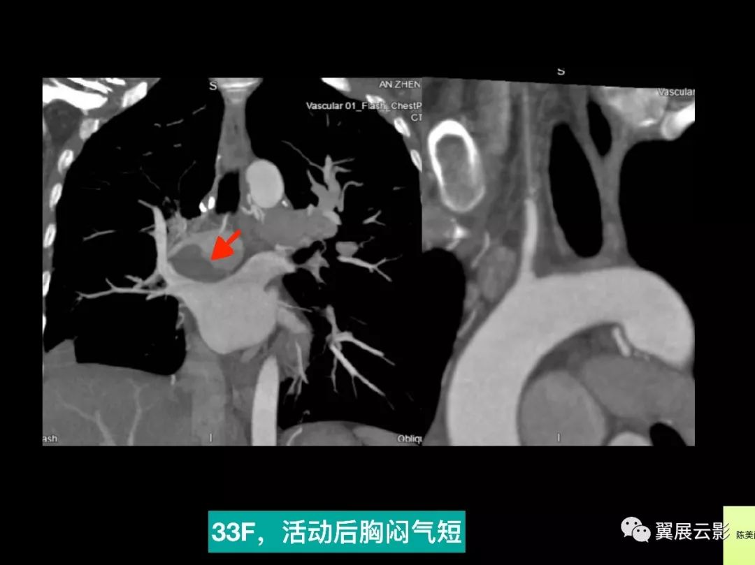 影像PPT - 【PPT】肺栓塞影像诊断与鉴别-39