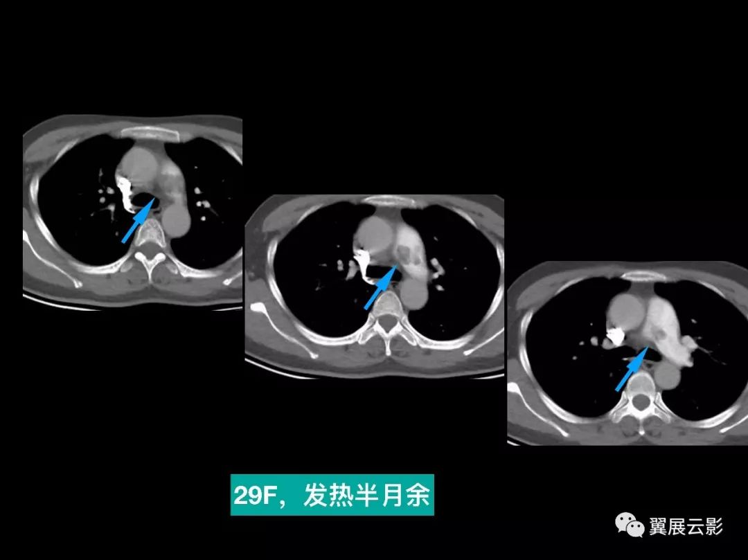 影像PPT - 【PPT】肺栓塞影像诊断与鉴别-41