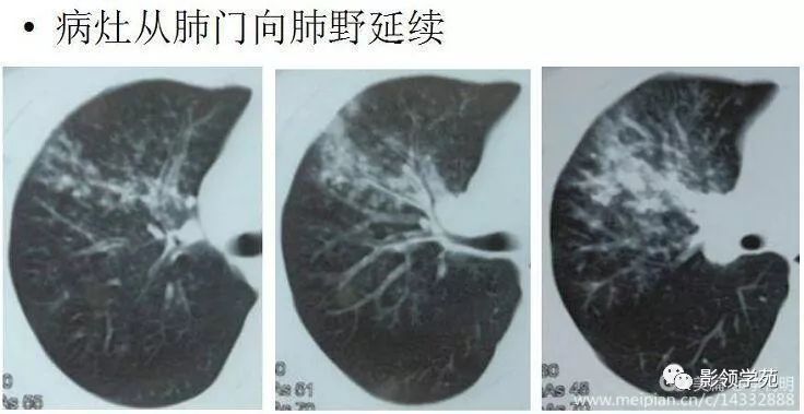 影像PPT - 支原体肺炎相关临床病理及影像知识点趣解-9 影像PPT - 支原体肺炎相关临床病理及影像知识点趣解-9