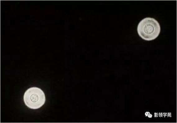影像PPT - 隐球菌的各种不同表现-13 影像PPT - 隐球菌的各种不同表现-13