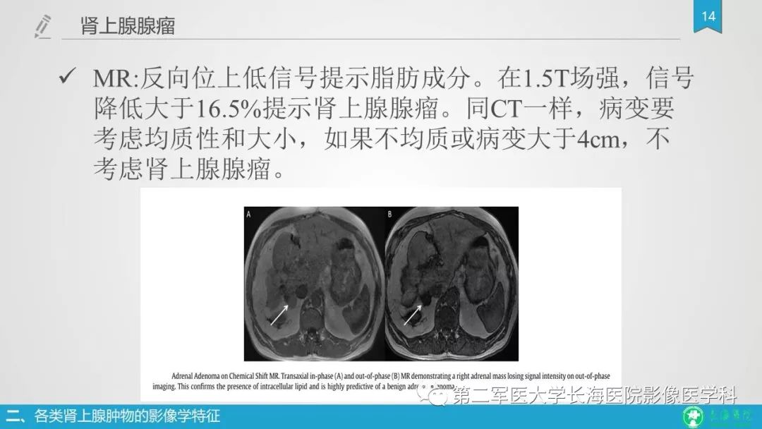 影像PPT - 【PPT】肾上腺肿物的分类及其影像学特点-14