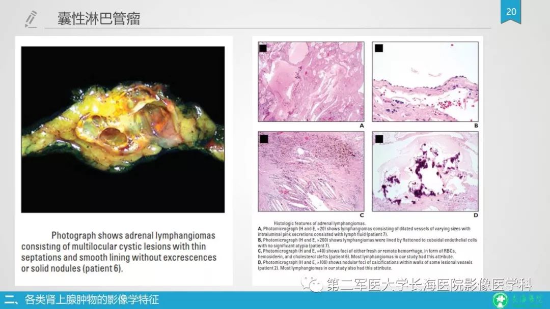 影像PPT - 【PPT】肾上腺肿物的分类及其影像学特点-20