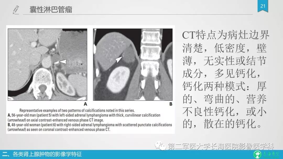 影像PPT - 【PPT】肾上腺肿物的分类及其影像学特点-21