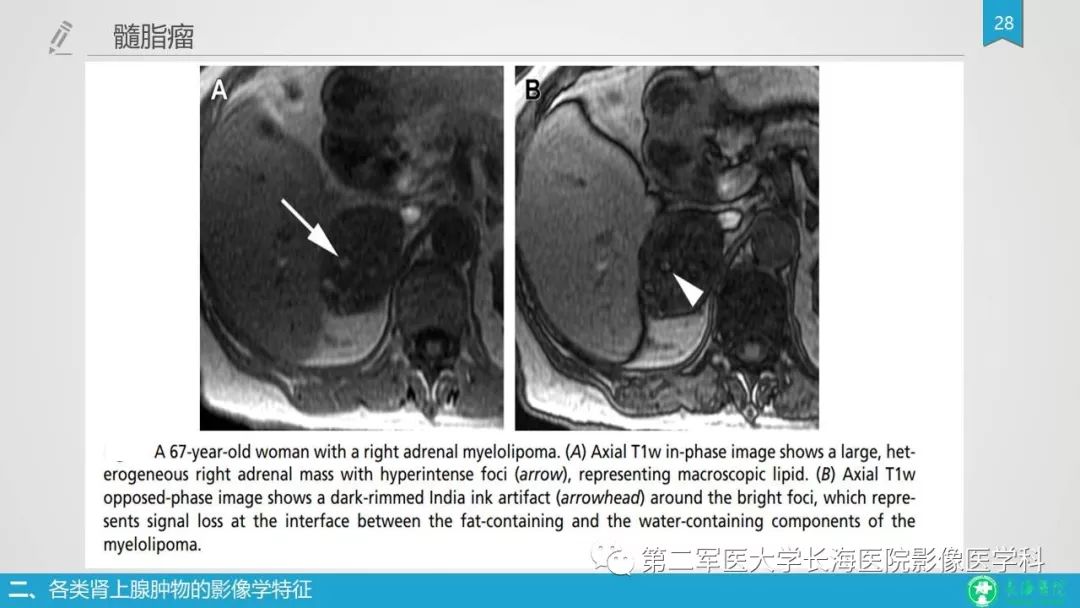 影像PPT - 【PPT】肾上腺肿物的分类及其影像学特点-28