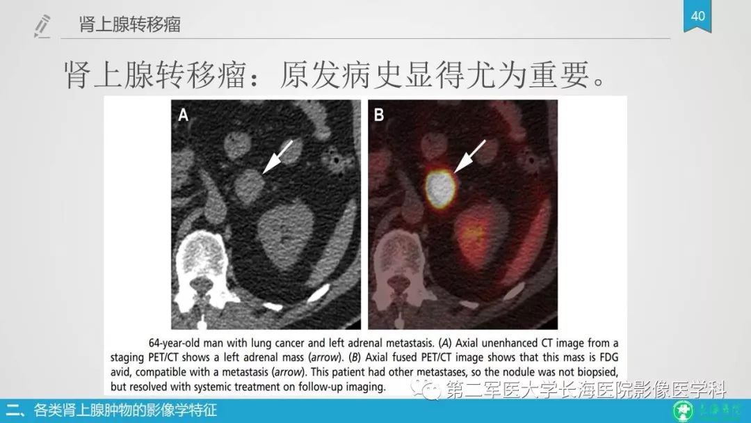 影像PPT - 【PPT】肾上腺肿物的分类及其影像学特点-40