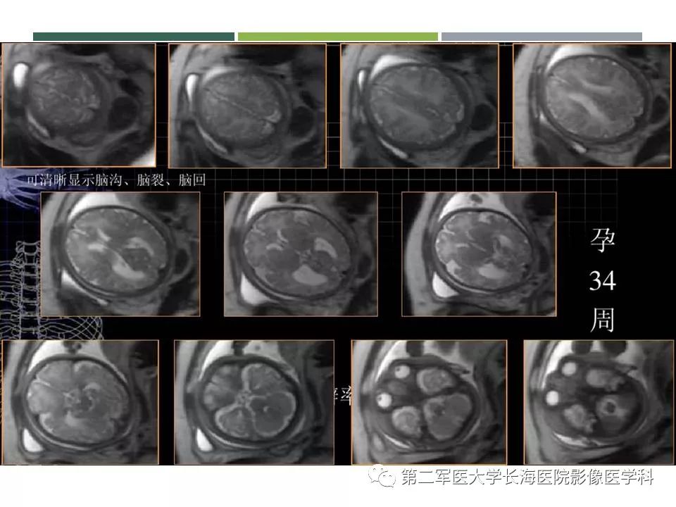 影像PPT - 【PPT】新生儿缺血缺氧性脑病的MR表现及相关解剖、生理基础-23