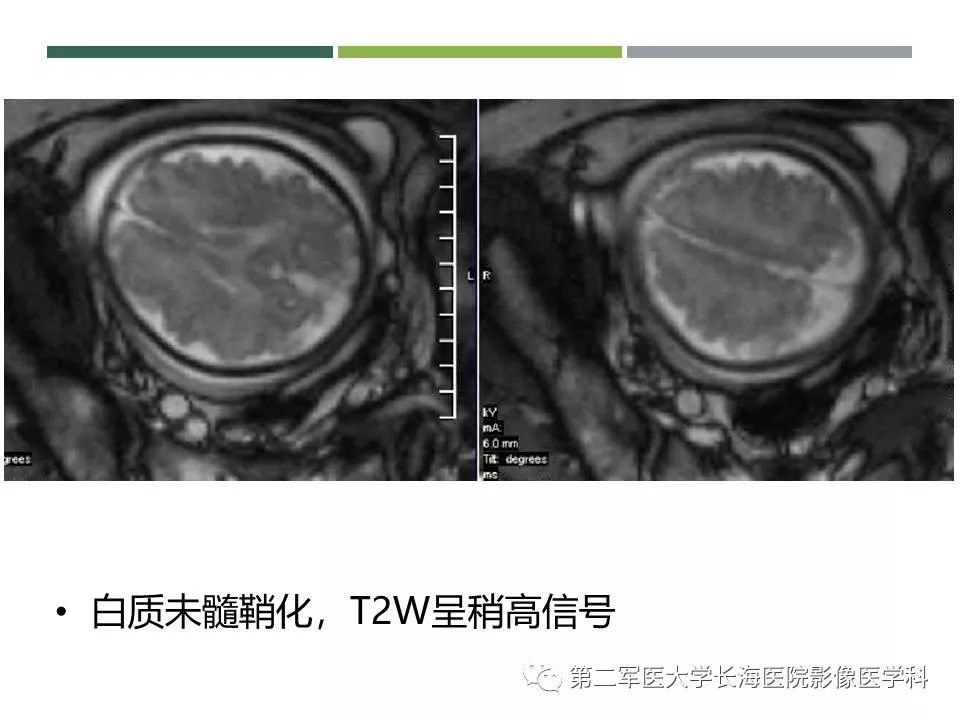 影像PPT - 【PPT】新生儿缺血缺氧性脑病的MR表现及相关解剖、生理基础-26