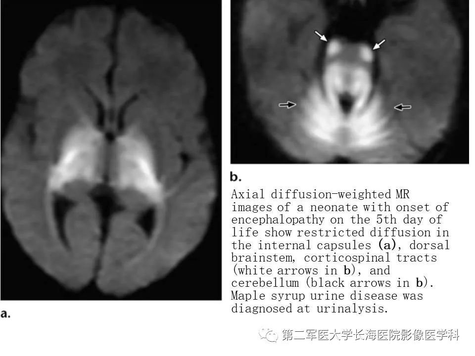 影像PPT - 【PPT】新生儿缺血缺氧性脑病的MR表现及相关解剖、生理基础-45