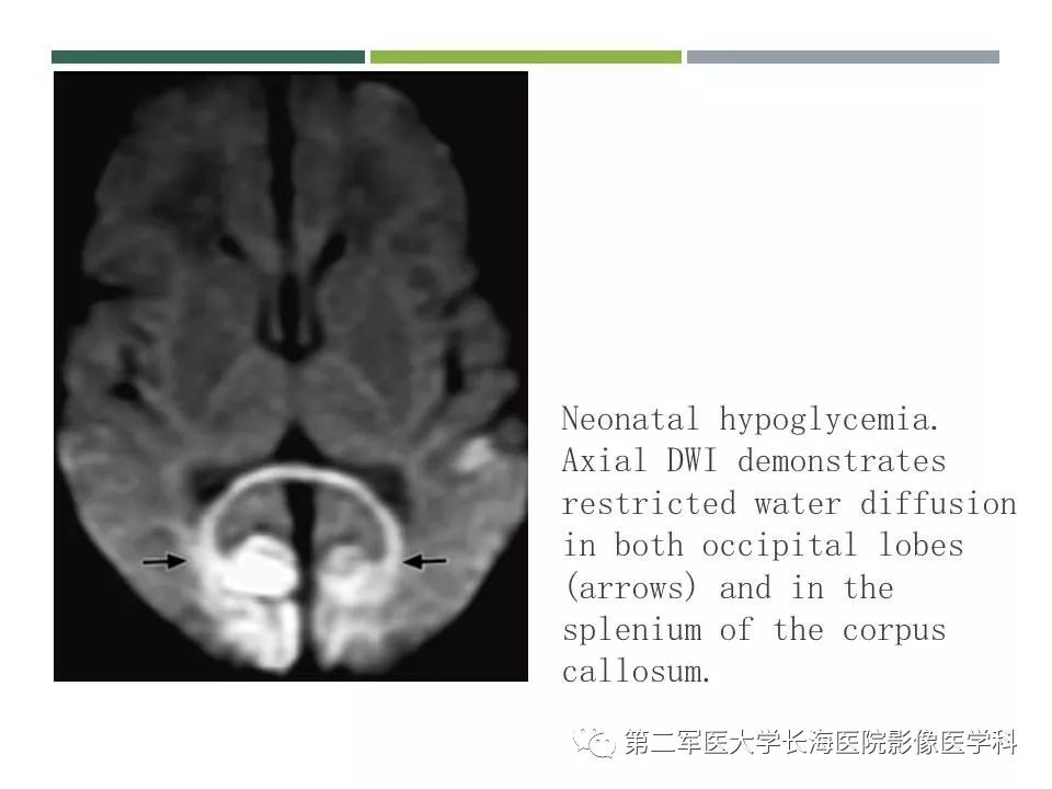 影像PPT - 【PPT】新生儿缺血缺氧性脑病的MR表现及相关解剖、生理基础-47