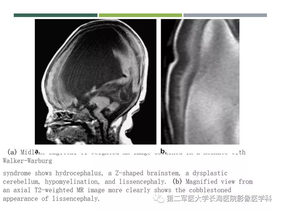 影像PPT - 【PPT】新生儿缺血缺氧性脑病的MR表现及相关解剖、生理基础-50