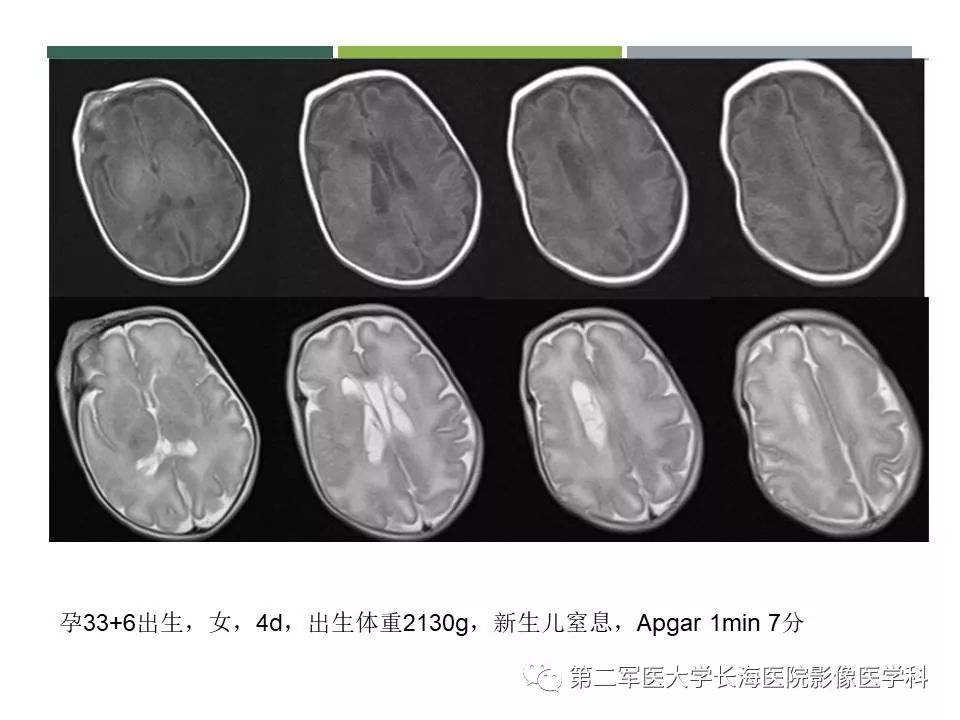 影像PPT - 【PPT】新生儿缺血缺氧性脑病的MR表现及相关解剖、生理基础-51