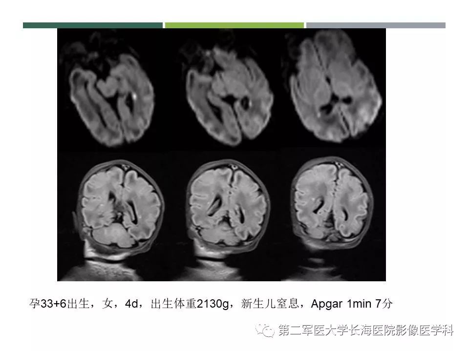 影像PPT - 【PPT】新生儿缺血缺氧性脑病的MR表现及相关解剖、生理基础-52