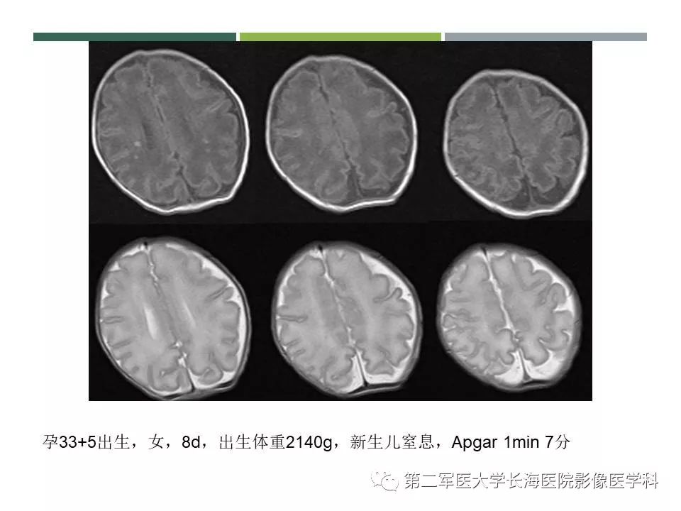 影像PPT - 【PPT】新生儿缺血缺氧性脑病的MR表现及相关解剖、生理基础-53