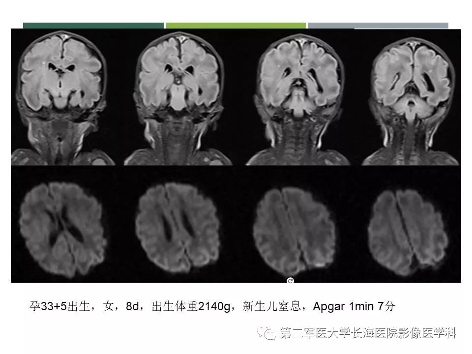 影像PPT - 【PPT】新生儿缺血缺氧性脑病的MR表现及相关解剖、生理基础-54