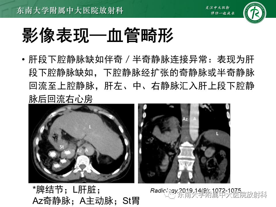 影像PPT - 【病例】多脾综合征1例CT影像-9