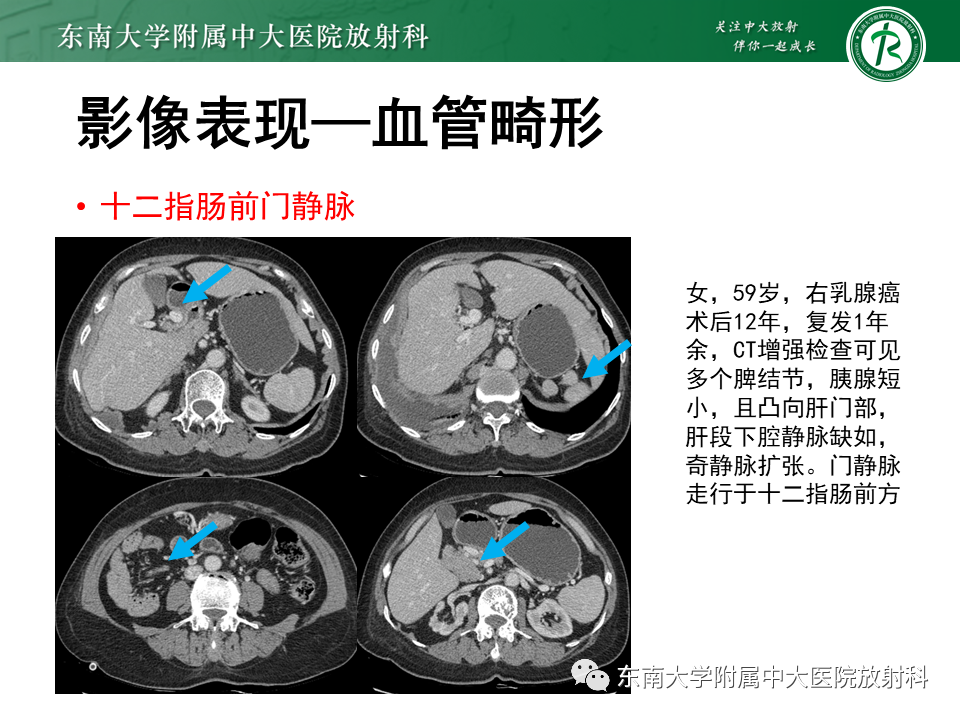 影像PPT - 【病例】多脾综合征1例CT影像-11