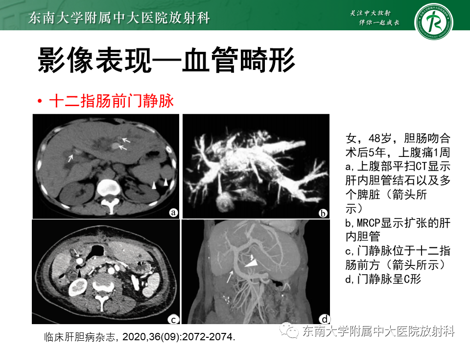影像PPT - 【病例】多脾综合征1例CT影像-12