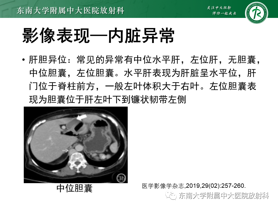 影像PPT - 【病例】多脾综合征1例CT影像-13