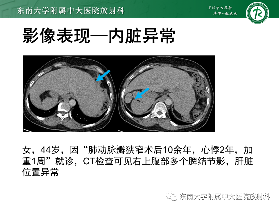 影像PPT - 【病例】多脾综合征1例CT影像-14