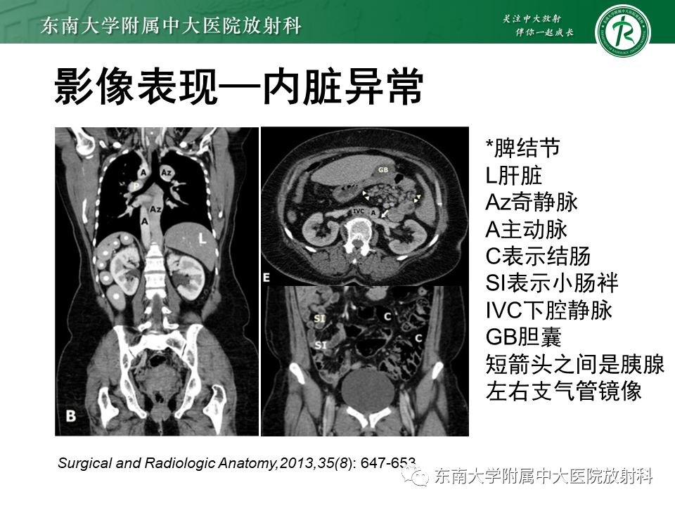 影像PPT - 【病例】多脾综合征1例CT影像-16