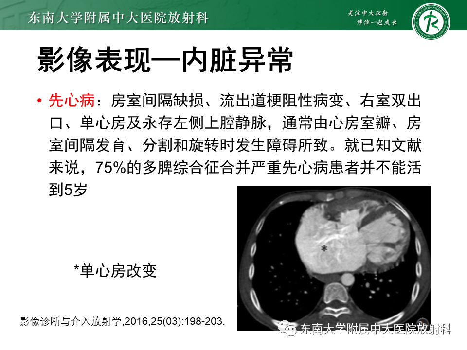 影像PPT - 【病例】多脾综合征1例CT影像-17