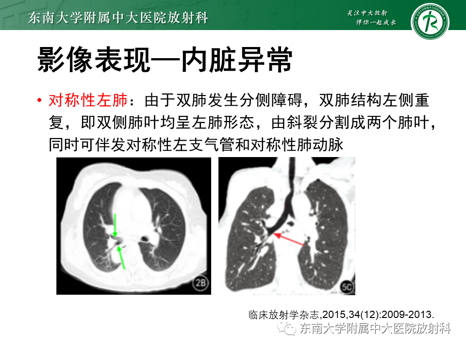 影像PPT - 【病例】多脾综合征1例CT影像-18