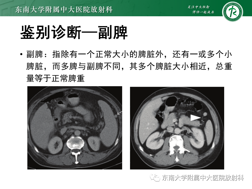 影像PPT - 【病例】多脾综合征1例CT影像-21
