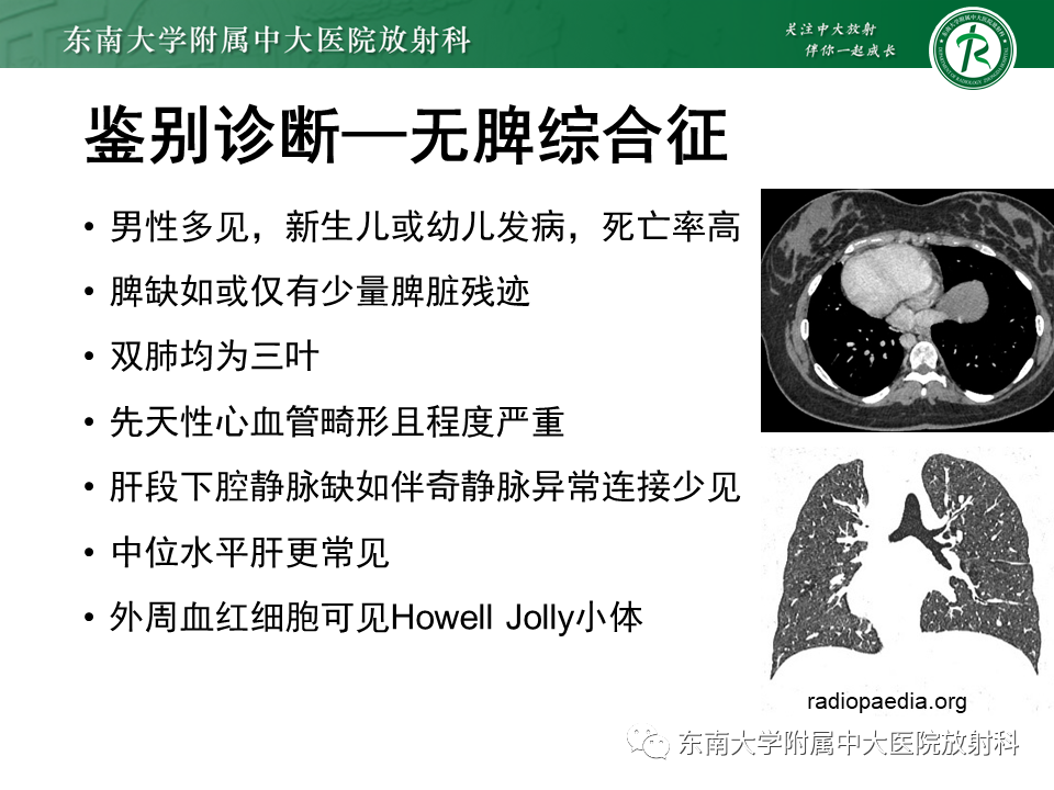 影像PPT - 【病例】多脾综合征1例CT影像-23