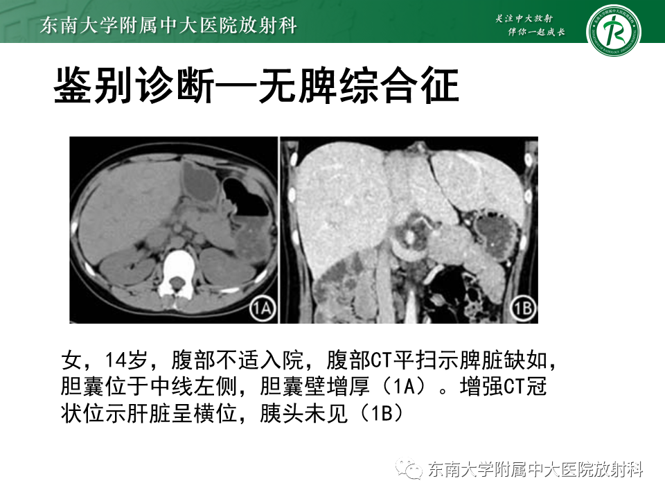 影像PPT - 【病例】多脾综合征1例CT影像-24