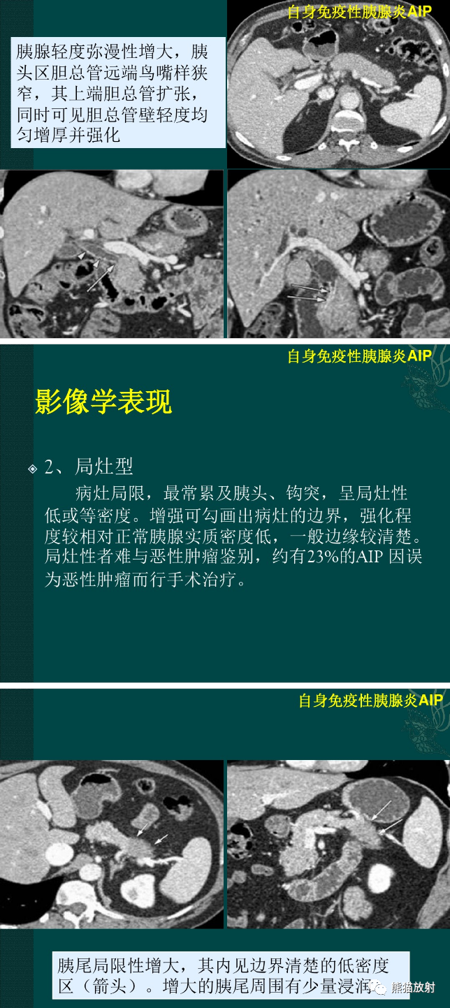 影像PPT - 【病例】自身免疫性胰腺炎1例MR影像-8 影像PPT - 【病例】自身免疫性胰腺炎1例MR影像-8