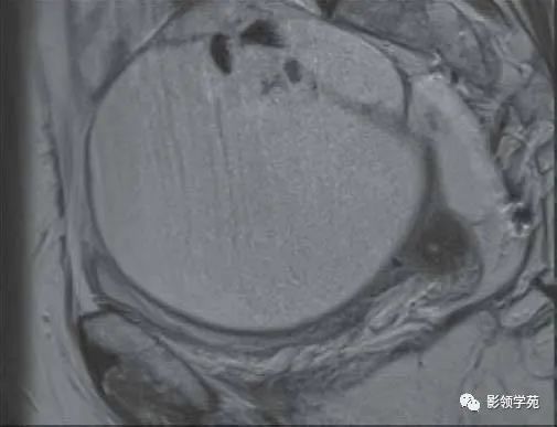 影像PPT - 【病例】卵巢浆液性囊性腺纤维瘤1例MR-2 影像PPT - 【病例】卵巢浆液性囊性腺纤维瘤1例MR-2