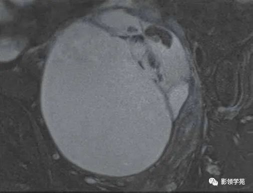 影像PPT - 【病例】卵巢浆液性囊性腺纤维瘤1例MR-3 影像PPT - 【病例】卵巢浆液性囊性腺纤维瘤1例MR-3
