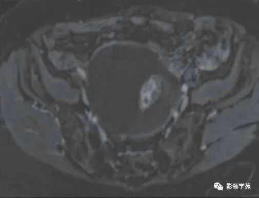影像PPT - 【病例】卵巢浆液性囊性腺纤维瘤1例MR-4 影像PPT - 【病例】卵巢浆液性囊性腺纤维瘤1例MR-4